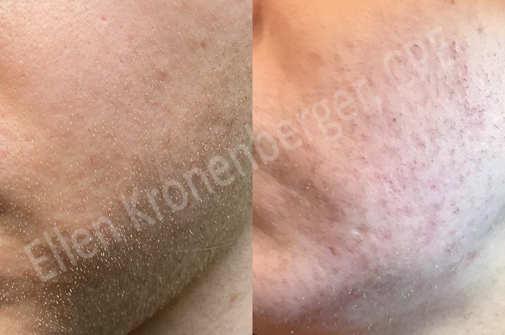 Zwischen den beiden Bildern liegen drei Jahre und 400 Stunden Elektroepilation. Haarfrei ist die Kundin immer noch nicht und die unprofessionelle Behandlung hat deutliche Spuren und eingewachsene Haare hinterlassen.