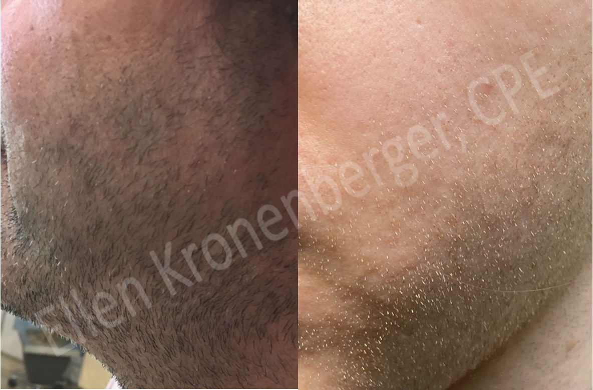 Bild links zeigt einen ausgeprägten männlichen Bartwuchs und eine mittelstarke Haardichte. Bild rechts zeigt einen weniger ausgeprägter Bartwuchs und eine etwas geringere Haardichte.