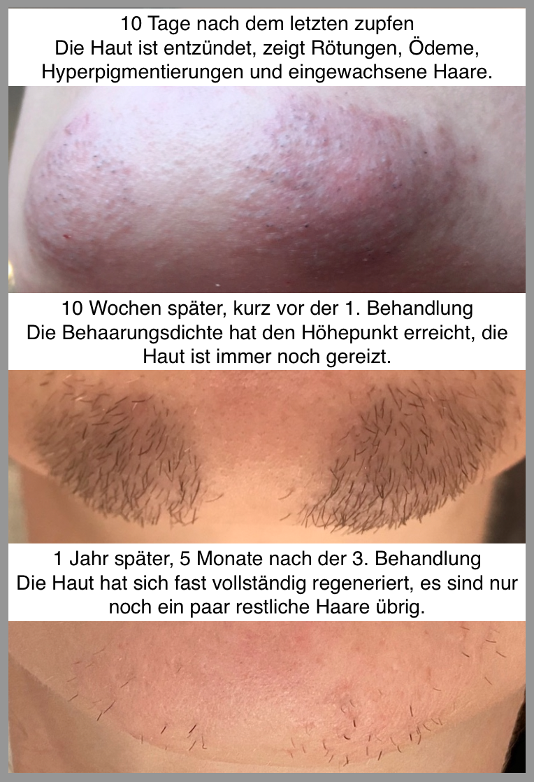 Elektro-Epilation Kinnhaare